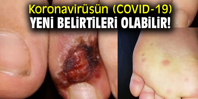 Koronavirüsün (COVID-19) yeni belirtileri olabilir! 