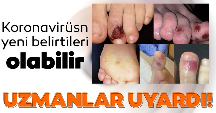 Corona virüsün yeni belirtileri olabilir