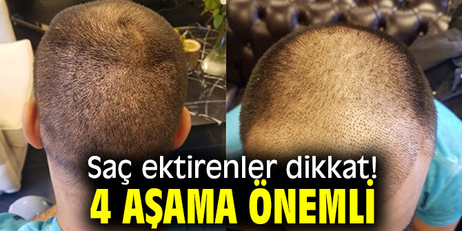 Saç ektirenler dikkat! 4 aşama önemli