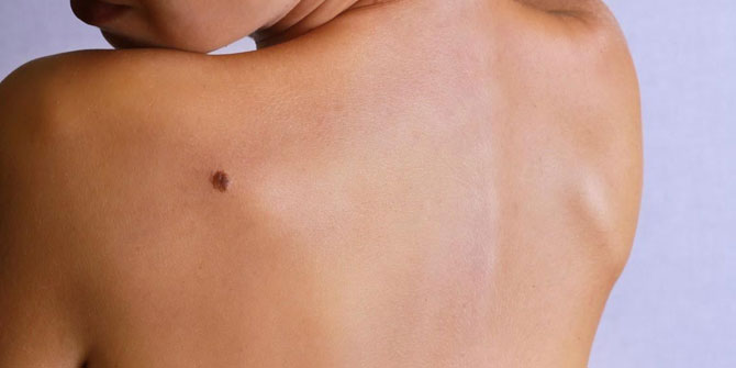 Uzmanı uyardı! Artan ben sayısı cilt kanseri habercisi olabilir