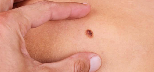 Cilt kanserinin tedavisinde büyük müjde!