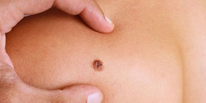 Dikkat! Cildinizdeki lekeler tümör habercisi olabilir!