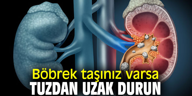 Uzmanı uyardı! Böbrek taşınız varsa tuzdan uzak durun