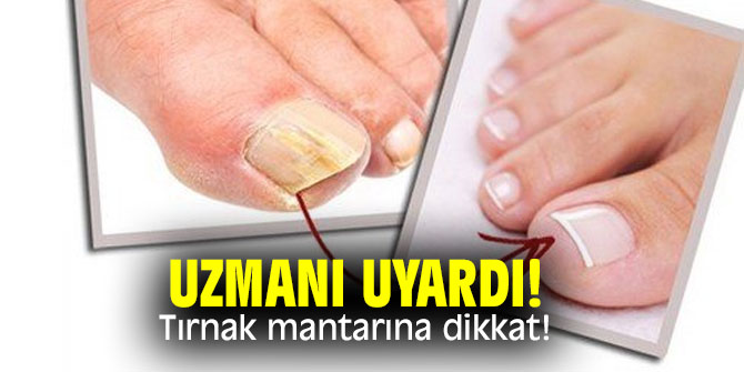 Dermatoloji Uzmanı uyardı! Tırnak mantarına dikkat!