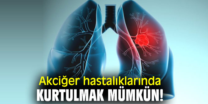 Akciğer hastalıklarından kurtulmak mümkün!