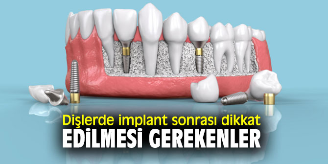 Dişlerde implant sonrası bunlara dikkat