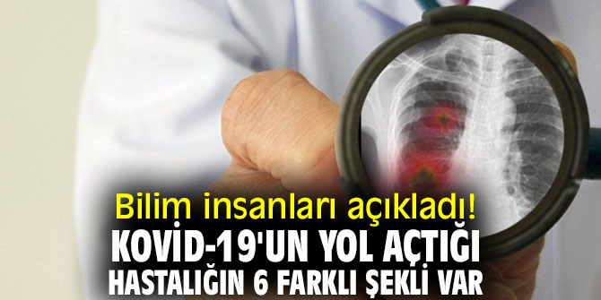 Bilim insanlarından flaş açıklama! İşte Kovid-19'un yol açtığı hastalığın şekilleri