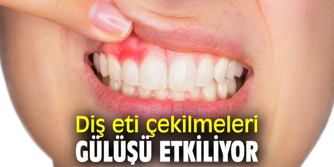 Aman dikkat! Diş eti çekilmeleri gülüşü etkiliyor