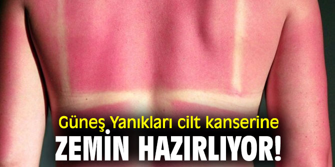 Güneş Yanıkları cilt kanserine zemin hazırlıyor!