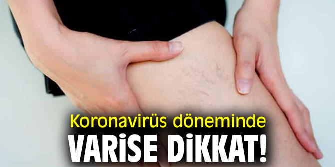 Uzmanı uyardı! Koronavirüs döneminde varise dikkat!