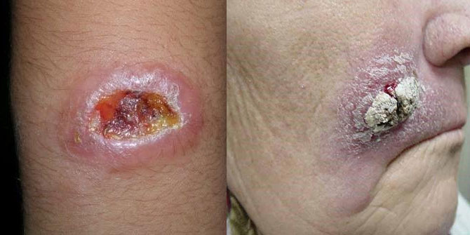 Şark çıbanı tanısına yeni ve kombine bir yaklaşım!