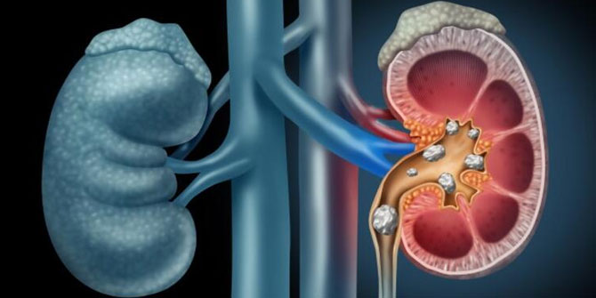 Böbrek taşlarında yeni tedavi yöntemi