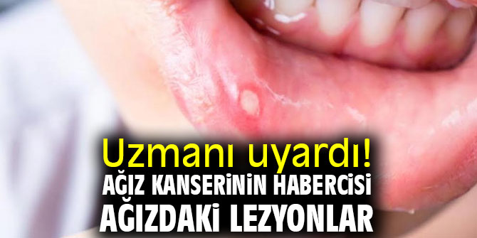 Uzmanı uyardı! Ağız kanserinin habercisi ağızdaki lezyonlar 