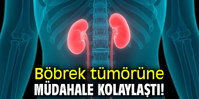 Böbrek tümörüne müdahale kolaylaştı!