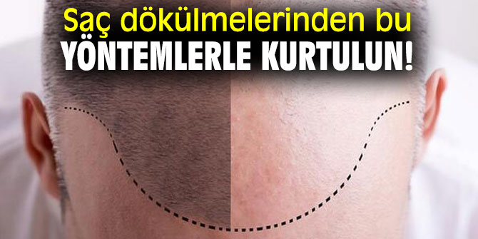 Saç dökülmelerinden bu yöntemlerle kurtulun!
