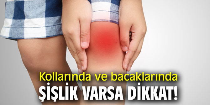 Uzmanı uyardı! Kollarında ve bacaklarında şişlik varsa dikkat!