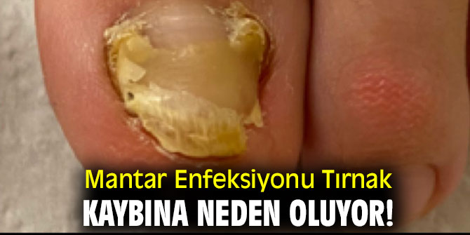 Mantar Enfeksiyonu Tırnak kaybına neden oluyor!