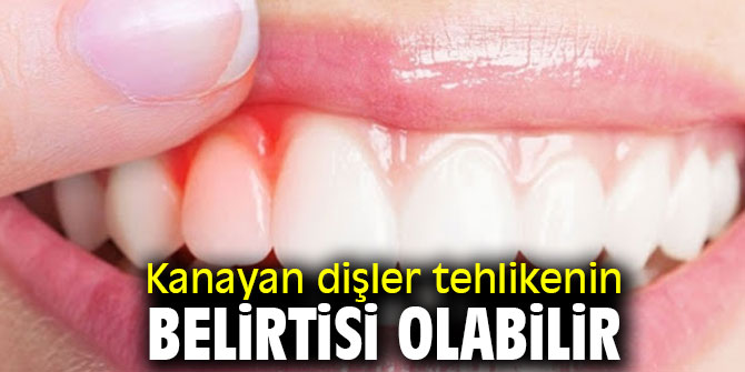 Uzmanı uyardı! Kanayan dişler tehlikenin belirtisi olabilir