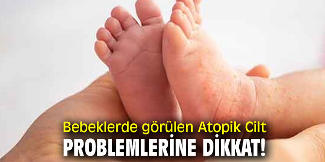 Bebeklerde görülen Atopik Cilt problemlerine dikkat!