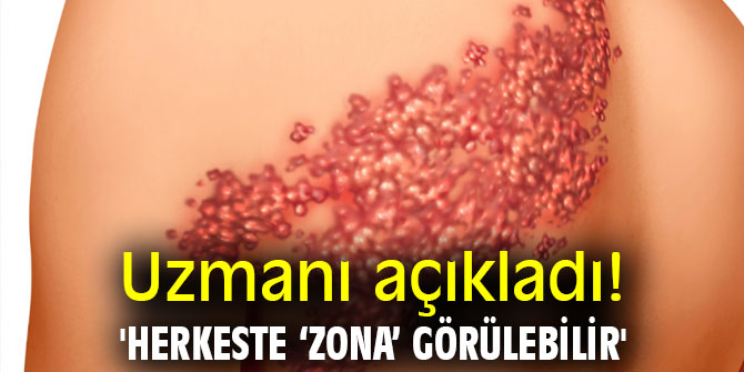 Uzmanı açıkladı! 'Herkeste ‘zona’ görülebilir'