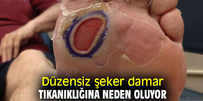 Düzensiz şeker damar tıkanıklığına neden oluyor