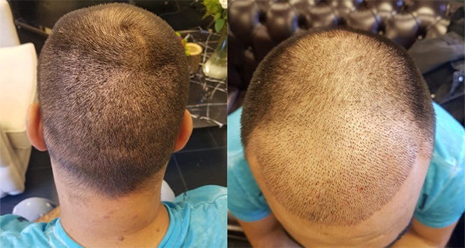 Sağlık turizmi 2021’den umutlu