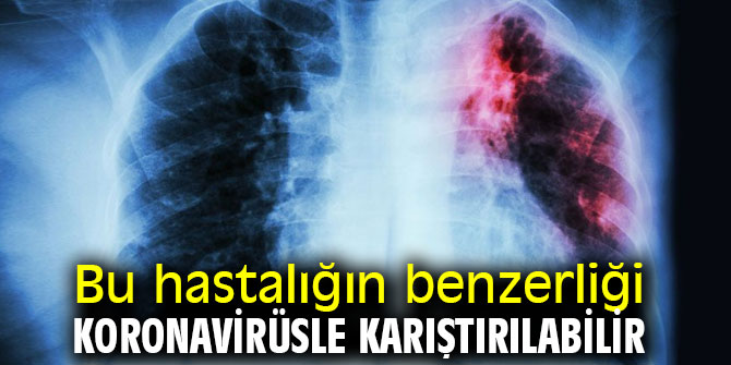 Bu hastalığın benzerliği koronavirüsle karıştırılabilir