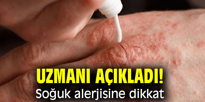 Uzmanı açıkladı! Soğuk alerjisine dikkat!