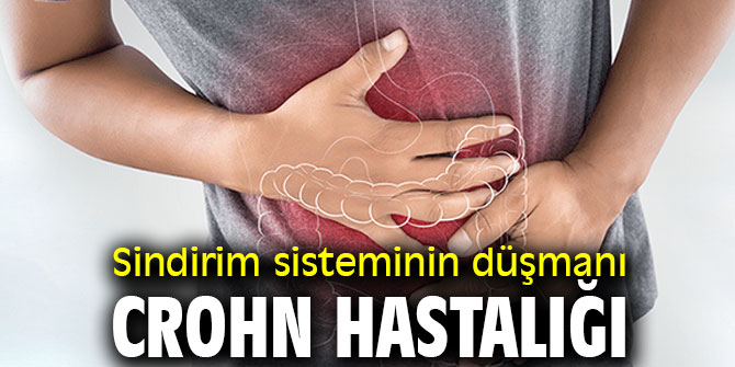 Sindirim sisteminin düşmanı Crohn hastalığına dikkat!