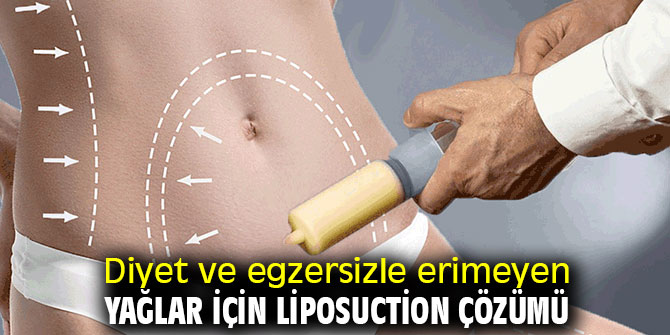 Diyet ve egzersizle erimeyen yağlara liposuction çözümü