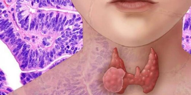 Ses kısıklığına dikkat! Tiroid kanserini işaret ediyor olabilir