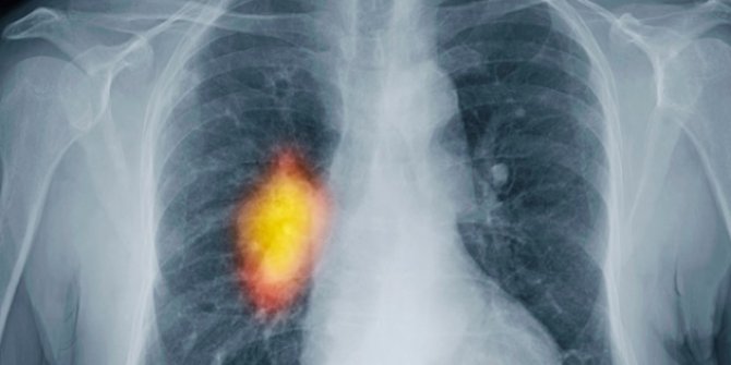 Akciğer kanserinde tedaviyi hastalığın evresi belirliyor