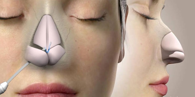 Rhinoplastide bunlara dikkat