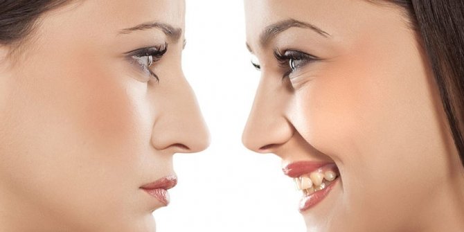 Rinoplasti Hakkında En Çok Konuşulan 11 MİT 