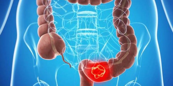 PANDEMİ KORKUSU KOLON KANSERİNDE GECİKMEYE YOL AÇIYOR