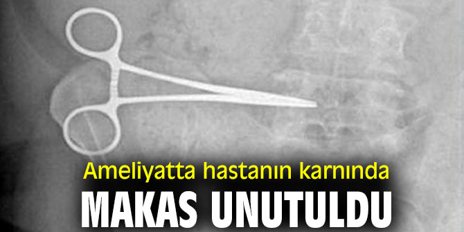 Şoke eden olay! Ameliyatta hastanın karnında makas unutuldu