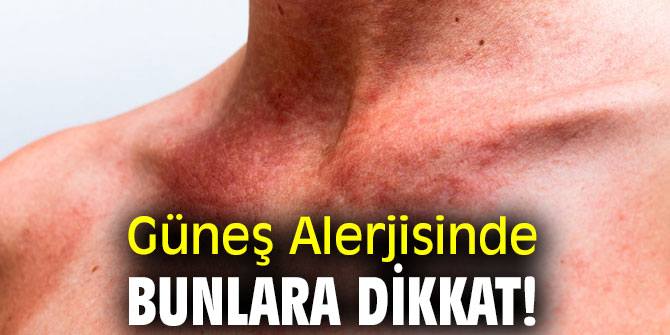 Güneş Alerjisinde bunlara dikkat!