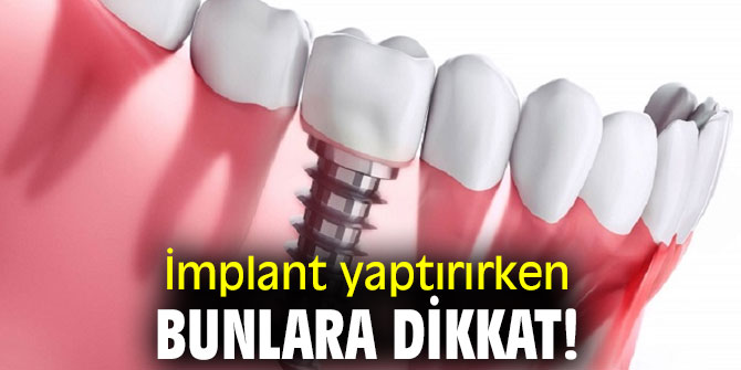 İmplant yaptırırken bunlara dikkat!