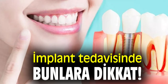İşte  implant tedavisinde başarının üç sırrı