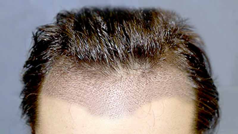 Saç Ekim Teknikleri – Smile Hair Clinic