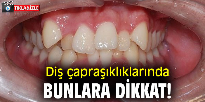 Diş çapraşıklıklarında bunlara dikkat!