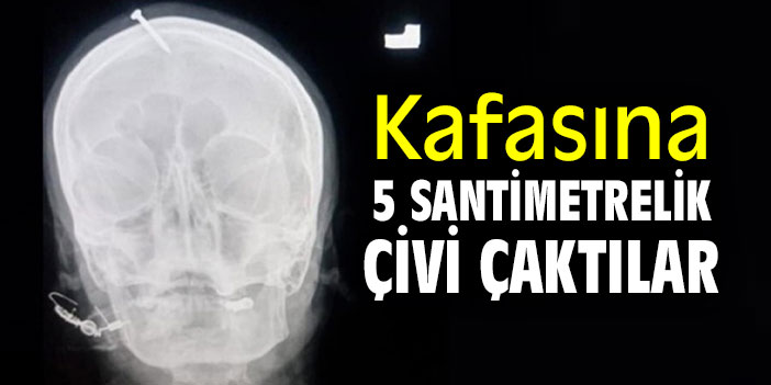 Kafasına 5 santimetrelik çivi çaktılar