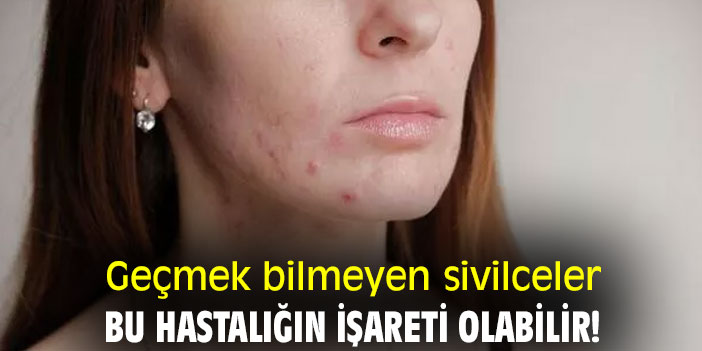 Geçmek bilmeyen sivilceler, bu hastalığın işareti olabilir!