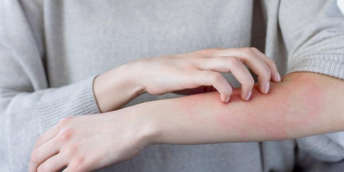 Uyuz vakaları artıyor