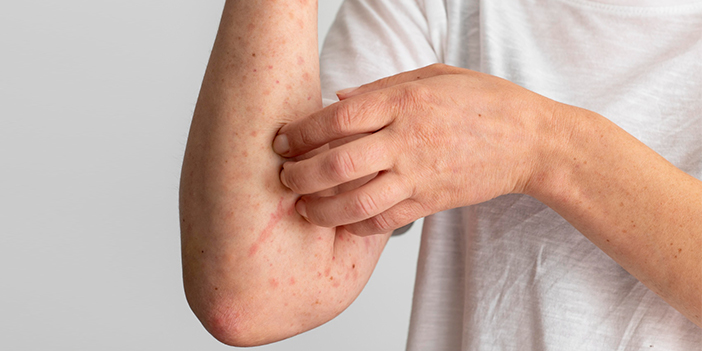 Kurdeşen belirtileri nelerdir?