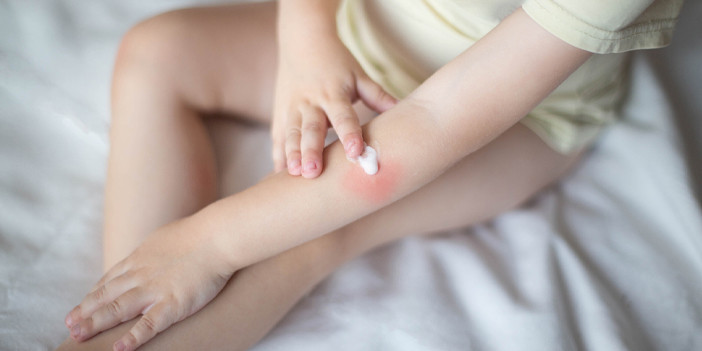 Yanığa yumurta akı sürmeyin!