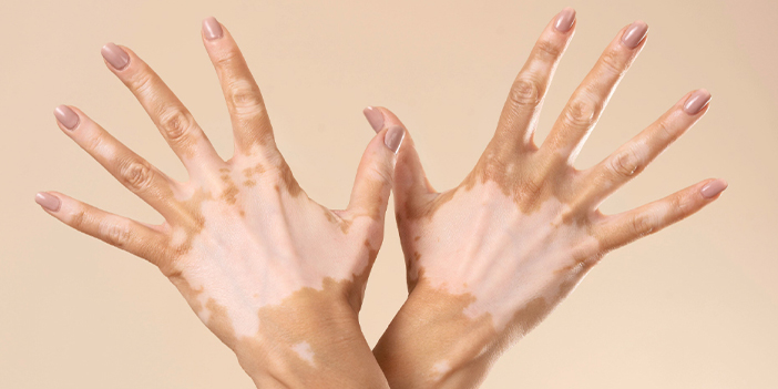 Vitiligoda tedavi mümkün mü?