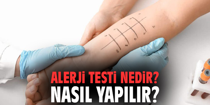 Alerji Testi Nedir? Nasıl Yapılır?