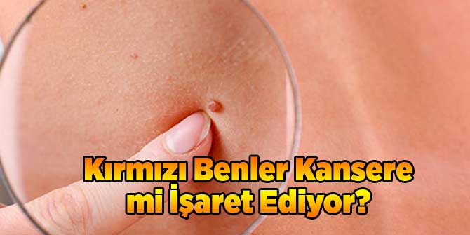 Kırmızı Benler Kansere mi İşaret Ediyor?