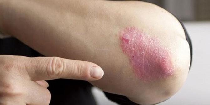 Sigara Bu Hastalığı Tetikliyor!